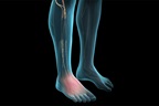 Complex Regional Pain Syndrome